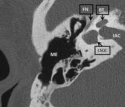 Case Report: Challenging Otologic Surgery in Patients With 22q11.2 Deletion Syndrome